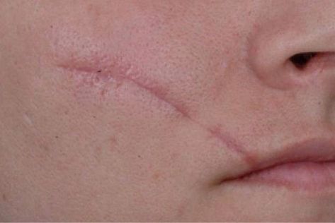 Get Rid Of Scars, Scar Remedies, Getting Rid Of Scars, Forehead Acne, Acne Scar Removal, Scar Removal, Skin Remedies, Acne Remedies, Instant Messaging