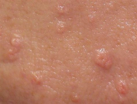 Skin Rash On Face, Ingrown Pimple, Skin Conditions Pictures, Skin Bumps On Face, Sebaceous Hyperplasia, Rash On Face, Skin Care Center, Pimples Under The Skin, Pimples On Face