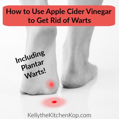 Do you know how to use apple cider vinegar to remove warts? It really works and I'm proof! I've even got a gross picture to prove it. Plantar Warts, Remove Warts, Tag Remover, Allergy Remedies, Get Rid Of Warts, Dear Reader, Prove It, Cider Vinegar, Apple Cider Vinegar