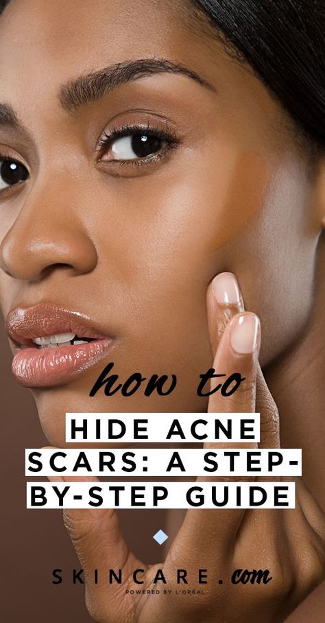 How To Hide Pimples, Zit Remedy, Acne Makeup, Pimple Scars, Bad Acne, Natural Acne Remedies, Skin Spots, Sharing Economy, Diy Remedies