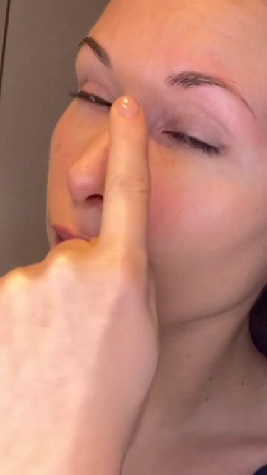 How To Get Rid Of Tear Troughs, Tear Trough Remedy Natural, Puffy Eye, Remove Eye Bags, Drainage Massage, Tear Trough, Eye Exercises, Face Exercises, Puffy Eyes