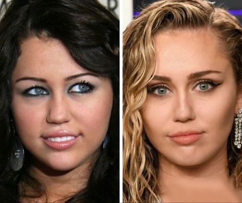 Miley Cyrus Before And After, Plastic Surgery Celebrities, Celebrity Surgery, Plastic Surgery Fail, Plastic Surgery Gone Wrong, Dark Secrets, Celebrity Plastic Surgery, The Kardashians, Nose Job