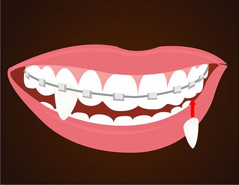 How to Make Vampire Fangs if You Have Braces: 12 Steps Fake Vampire Teeth, Fake Fangs, Halloween Fangs, Teenage Werewolf, Vampire Halloween Costume, Vampire Costumes, Vampire Fangs, Vampire Teeth, Electric Daisy Carnival