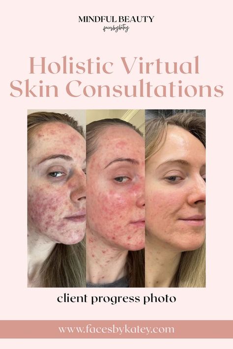 Those who may not be a fit for a virtual consult call include: those who desire to purchase from outside vendors, reside outside of Canada/USA, those who do not wish to commit to a routine, or those who are on a strict budget at this time. Visit Mindful Beauty to book your consultation today! Skin Transformation, Skin Clearing, Skin Care Acne, Clear Skin, From Home, Budgeting, Your Skin, Acne, Mindfulness