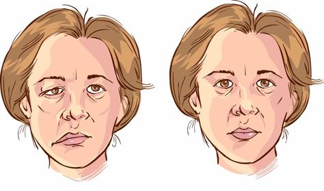 Bell’s Palsy, Muscles Of The Face, Bells Palsy, Facial Nerve, Muscle Weakness, Facial Muscles, Medical Tourism, Alternative Treatments, Reflexology