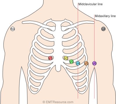 12-lead-ecg-placement Cardiac Physiologist, 12 Lead Ekg Placement, Ekg Placement, Ecg Placement, Lead Placement, Cardiac Dysrhythmias, Ekg Leads, Ekg Tattoo, Emt Study