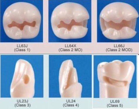 1,056 Likes, 9 Comments - DENTISTRY TODAY® (@dentistry2day) on Instagram: “All Class Restorations 😷👌 Photo via @vigangoga follow him for more pics👈  Tag your friends 👇…” Dental Classification, Dental Assistant Study Guide, Dental Assistant School, Dental Assistant Study, Dental Hygiene Student, Dental Images, Dental Assisting, Dental World, Dental Videos