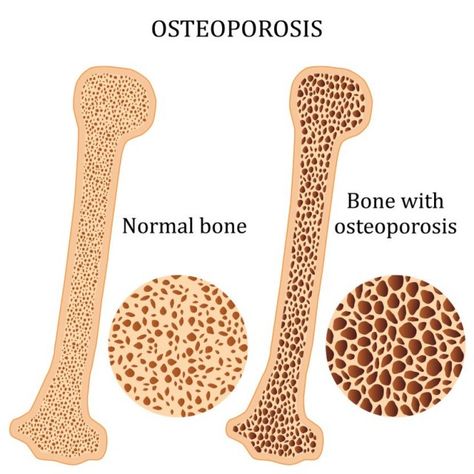 Normal Bone and Bone with Osteoporosis Comparison Osteoporosis Symptoms, Eye Twitching, Weight Bearing Exercises, Nutrition Club, Bone Strength, Bone Loss, Bone Density, Healthy Bones, Fall Prevention