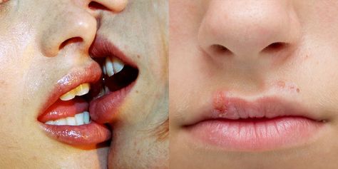 5 Diseases And Infections You Can Get From Kissing Kissing Disease, Swollen Lips, Sore Lips, Body Fluid, Body Ache, Cold Sore, Shaving Razor, Lip Hair, Perfect Lips