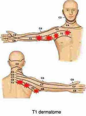 Tingling right hand, ache in arm, pain in arm pit and front right of chest, and pain in back by shoulder blade and side of neck.  All on the right.  Several Tingling In Fingers, Pain In Back, Punkty Spustowe, Severe Back Pain, Pinched Nerve, Spine Health, Upper Back Pain, Muscle Anatomy, Medical Anatomy