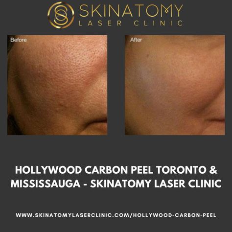 Several distinct skin imperfections can be treated with a Hollywood Carbon Peel, a specialised carbon laser procedure. It can help treat acne and enlarged pores, lessen the visibility of fine lines and scars, even out skin tone, and improve skin tone. This noninvasive procedure improves skin tone and makes it feel and appear smoother and younger. Hollywood Peel, Carbon Peel, Carbon Laser, Laser Peel, Laser Clinic, Laser Clinics, Celebrity Plastic Surgery, Treat Acne, Skin Imperfection