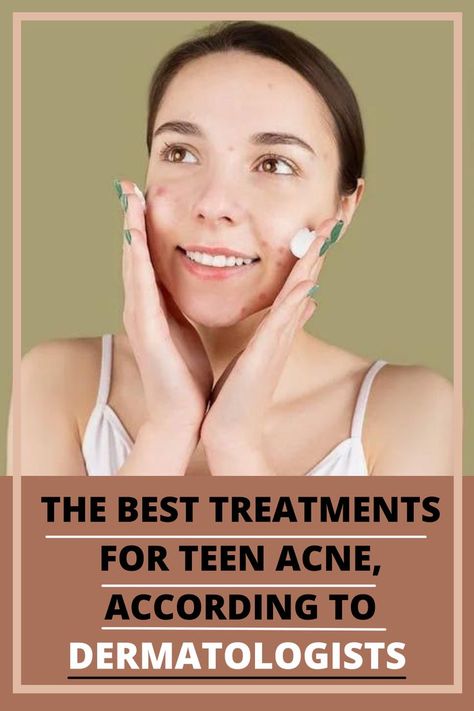 Face Mapping Acne, Acne Prone Skin Care, Oily Skin Acne, How To Get Rid Of Pimples, Face Acne, Acne Spots, Skin Care Acne, Acne