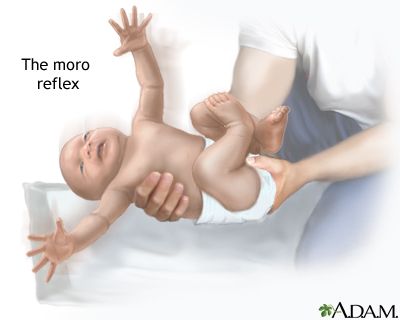 The Moro reflex is a normal reflex for an infant when he or she is startled or feels like they are falling. The infant will have a "startled" look and the arms will fling out sideways with the palms up and the thumbs flexed. Absence of the Moro reflex in newborn infants is abnormal and may indicate an injury or disease. From the NIH Primitive Reflexes, Sleep Strategies, Pediatric Physical Therapy, Pediatric Occupational Therapy, Sleep Training Baby, Sleeping Through The Night, Sleep Training, Healthy Babies, Baby Health