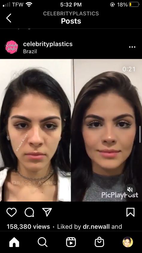 Bulbous Nose Rhinoplasty Before After, Lip Job, James Fridman, Photoshop Edits, Rhinoplasty Nose Jobs, Face Fillers, Facial Routine Skincare, Plastic Surgery Gone Wrong, Rhinoplasty Before And After