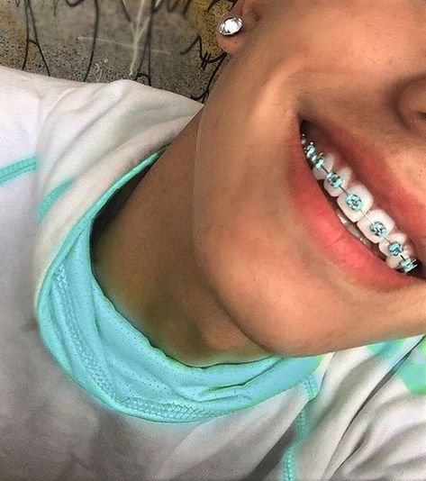 Dental Braces Colors, Braces Colors Combinations, Invisible Teeth Braces, Guys With Braces, Natural Teeth Whitening Diy, Braces Bands, Cute Braces Colors, Kids Braces, Braces Tips