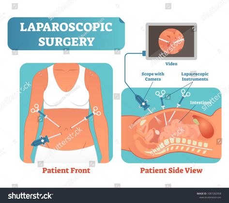 Laparoscopic surgery medical health care surgical procedure process, anatomical cross section vector illustration diagram. Laparoscopy instruments with camera and screen. #Ad , #ad, #procedure#surgical#anatomical#process Laparoscopic Surgery Instruments, Female Surgeon, Prescription Pad, Doctor Quotes, Medical Health Care, Smart Girl, Laparoscopic Surgery, Medical Health, Med Student