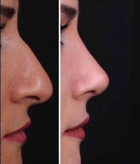 Rhinoplasty Droopy Tip, Natural Rhinoplasty Nose Jobs, Petite Nose, Rhinoplasty Aesthetic, Natural Rhinoplasty, Nose Job Natural, Dorsal Hump Rhinoplasty, Ideal Nose Rhinoplasty, Nose Inspiration Rhinoplasty