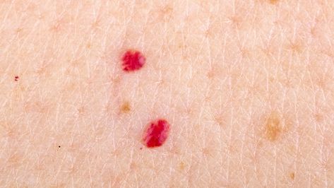 Here's What Some Of Those Red Marks On Your Skin Mean Cherry Angioma Removal, What Are Skin Tags, Cherry Angioma, Red Moles, Remove Skin Tags Naturally, Skin Growths, Skin Spots, Red Marks, Laser Therapy