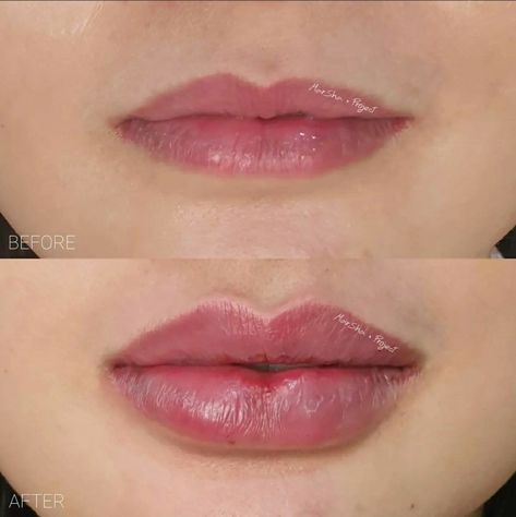 Heavy Lower Lip Filler, Lip Filler Technique, Lip Augmentation, Lip Filler, Lip Enhancement, Lower Lip, Bottom Lip, Glo Up, Lip Shapes