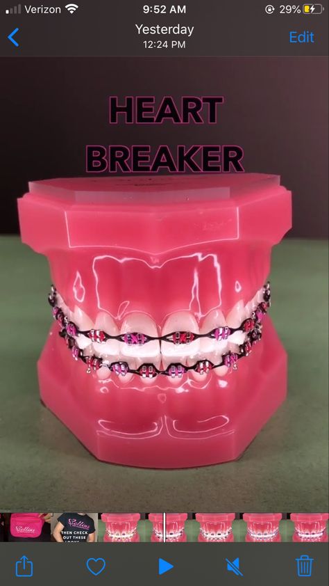 Things You Need For Braces, Valentine’s Day Braces Colors, Pink And Red Braces, Heart Shaped Braces, Braces Combos, Pretty Braces, Power Chain Braces, Dental Braces Colors, Braces Colors Combinations