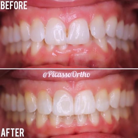 Picasso Orthodontics’s Instagram profile post: “Look at this beautiful transformation! Notice the correction of the overbite 🤩 • • • #picasso #picassoortho #orthodontics #orthodontist…” Lokai Bracelet, Live Lokai Bracelet, That Look, Look At, Instagram Profile, Instagram