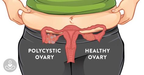 How to Lose Weight Even If You Have PCOS: 8 Science-Backed Tips | The Hearty Soul Polysistic Ovarian Syndrome, Fertility Yoga, Polycystic Ovarian Syndrome, Polycystic Ovaries, Detox Drinks Recipes, Healthy Heart, Planet Fitness Workout, Health Advice, Health Diet