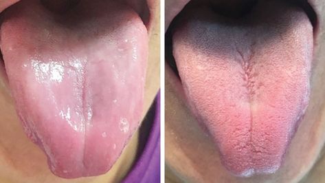 Bizarre photo shows man's smooth tongue after his taste buds disappear | CTV News https://www.ctvnews.ca/health/bizarre-photo-shows-man-s-smooth-tongue-after-his-taste-buds-disappear-1.4659200 Tongue Muscles, Medical Journal, Bizarre Photos, Medical Journals, Medicine Journal, Red Blood Cells, Blood Cells, Stick It Out, Taste Buds