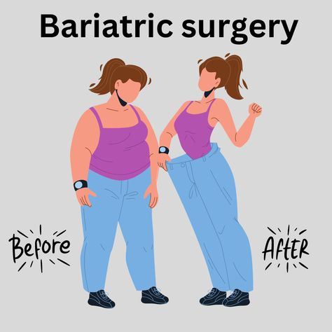 Are you struggling to lose weight and improve your health? Bariatric surgery in Dubai could be the solution you've been searching for! Dubai is becoming the center of all types of plastic surgery including Bariatric surgery. It is a weight loss surgery that is performed for reducing the size of the stomach or rerouting the small intestine. You will get to know all about Doctors, costs, and hospitals for Bariatric surgery in Dubai. #weightloss #weightlosssurgery #bariatricsurgery #weightlossdubai Bariatric Surgeries, Dubai 2023, Bariatric Surgeon, Small Intestine, Sleeve Gastrectomy, Types Of Surgery, Laparoscopic Surgery, General Surgery, Best Hospitals