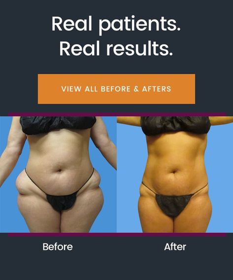 Laser Lipo Before And After, Sonobello Before And After Stomach, Sono Bello Before And After, Sonobello Before And After, Laser Lipo Treatments, Laser Lipo Benefits, Lipo Recovery Tips, Lipo 360 After Care, Lipo Before And After