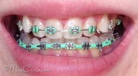 Mint Green Braces, Power Chain Braces, Braces Colors Combinations, Invisible Teeth Braces, Braces Retainer, Green Braces, Power Chain, Natural Teeth Whitening Diy, Cute Braces Colors