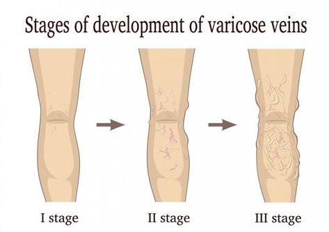 How to Hide Varicose Veins - Step 2 Purple Veins, Slow Movement, Improve Metabolism, Lymph Nodes, Boost Energy Levels, Circulatory System, Beauty Regimen, Herbal Extracts, Blood Circulation