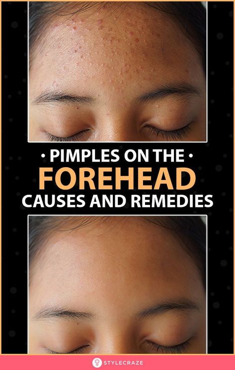 Acne is characterized by the appearance of small, red, and inflamed bumps on your skin and forehead. This happens as a result of clogged pores as you are likely to be exposed to pollution, dust, and other impurities. #Acne #Pimples #ForeheadAcne #Skincare #Remedies #Beauty #BeautyTips Small Pimples On Face, Get Rid Of Forehead Acne, Forehead Acne Cause, Small Bumps On Face, Forehead Bumps, Pimples On Forehead, Face Mapping Acne, Forehead Acne, Pimples Remedies