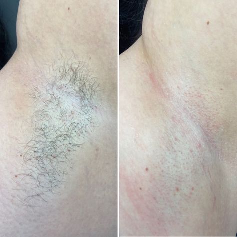 Skin Laser Before And After, Waxing Content, How To Lighten Underarms, Esthetician Posts, Underarm Waxing, Waxing Services, Dark Underarms, Sugar Waxing, Instagram Beauty