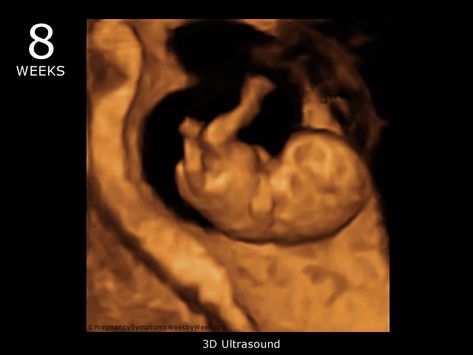 Baby Ultrasound taken during the 8th week of pregnancy. 8 Weeks Pregnant Ultrasound, 7 Week Ultrasound, 9 Week Ultrasound, 8 Week Ultrasound, 3d Ultrasound Pictures, 8 Weeks Pregnant, Pregnant Ultrasound, Pregnancy Insomnia, 26 Weeks Pregnant