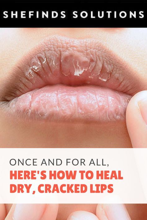 Dry Lips Remedy, Lip Healing, Lip Care Tips, Dry Cracked Lips, What Is Health, Skin Natural Remedies, Health Signs, Cracked Lips, Chapped Lips