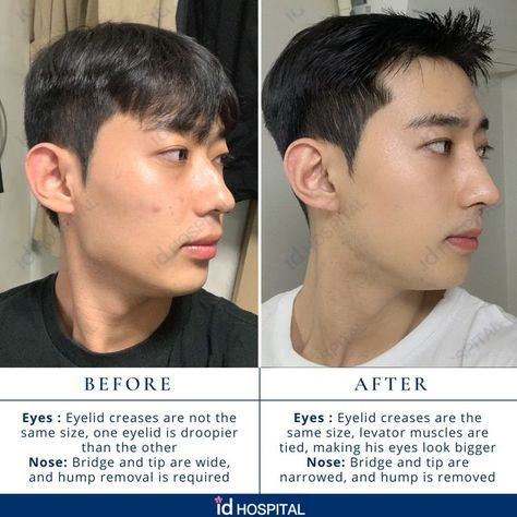 This Korean male patient wanted to get plastic surgeries at ID Hospital, to have a more defined nose and bigger eyes with even eyelid creases.
Surgeries he had:
🌠 Rhinoplasty with osteotomy and hump reduction
🌠 Incision Ptosis Correction
#idhospitalkorea #koreanplasticsurgery #plasticsurgery #plasticsurgerykorea #seoul #korea #rhinoplasty #rhinoplastybeforeandafter #asianrhinoplasty #nosejob #nosejobbeforeandafter #maleplasticsurgery #plasticsurgeryformen #IDtransformation #IDbeforeandafter Defined Nose, Plastic Surgery Korea, Korean Plastic Surgery, Bigger Eyes, Rhinoplasty Before And After, Nose Job, Seoul Korea, Plastic Surgery, Seoul