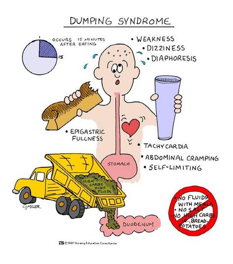 Possible post op complication for Gastroduodenostomy (Billroth I) or Gastrojejunostomy (Billroth II).. The minute they complain of cramps, listen for borborygmus sounds. the pt will have the urge to defecate, they'll be sweating, have dizziness and palpitations. Nursing Terminology, Gi Nursing, Counselling Tips, Dumping Syndrome, Nursing School Life, Nursing Study Tips, Young And, Clinical Nutrition, Nclex Review