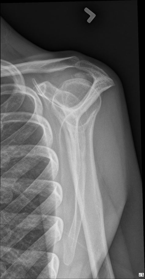 Calcific tendonitis of the shoulder - Musculoskeletal Medicine for Medical Students - OrthopaedicsOne Shoulder Xray, Xray Pictures, Rotator Cuff, Anime Muslim, Carpal Tunnel, Shoulder Pain, Radiology, Medical Students, X Ray