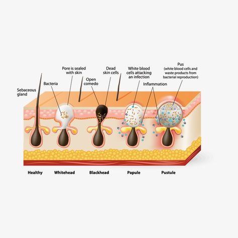 Skin Script, Skin Analysis, Acne Diet, Baby Acne, Forehead Acne, Low Glycemic Diet, Natural Skincare Brands, Natural Acne, Types Of Acne