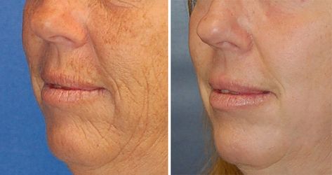 Erbium laser resurfacing is a highly effective way to dramatically reduce facial wrinkles, but it does have some significant downtime. Erbium Laser Resurfacing, Erbium Laser, Types Of Facials, Fractional Laser, Laser Resurfacing, Skin Balm, Yag Laser, Facial Wrinkles, Crepey Skin