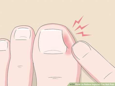 5 Ways to Relieve Ingrown Toe Nail Pain - wikiHow Toenail Pain, Infected Toenail, Nail Remedies, Nail Fungus Remedy, Ingrown Toenail, Nail Infection, Ingrown Nail, Fungal Nail, Brittle Nails