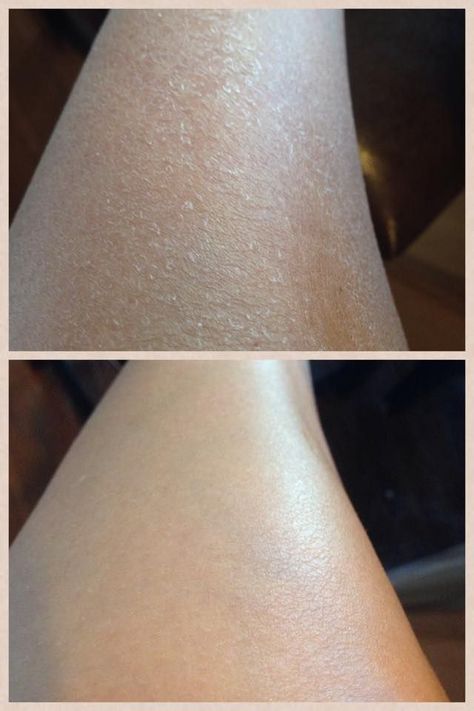 It's not always about the face. I don't know about you, but my legs are peeling and flaking so bad with this dry winter weather. Here is a before and after picture using the MD Paste and our body lotion ONE TIME! FLAKES ARE GONE! Love our products. Message me to get rid of your flaky, dry legs! www.michelebruni.myrandf.com Microdermabrasion Benefits, Clear Skin Detox, Dry Legs, Dry Skin Causes, Dry Skin Care Routine, Dry Flaky Skin, Dry Skin On Face, Dry Skin Body, Peeling Skin