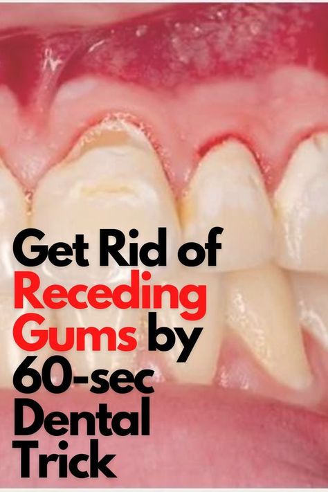 Learn How You Can Fix Your Bleeding Gums At Home. Best Strategy That Can Kill Every Other Method in the world. #gumcare #teethcare #teethcleaning #teethfixed #toothproblem #gumproblems Dental Hacks, Grow Back Receding Gums, Fix Teeth, Teeth Health, Receding Gums, Gum Care, Gum Health, Teeth Care, Oral Health Care