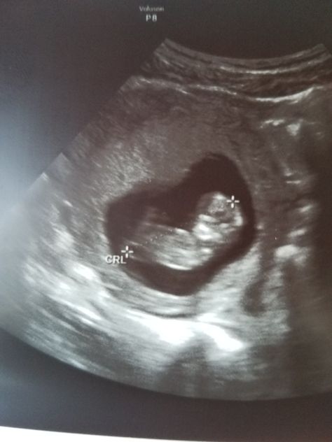 Scarlett's 11 week ultrasound  💗 11 Week Ultrasound, Chemistry Periodic Table, Pregnancy Ultrasound, Moral Orel, Dance Coach, 7 Months Pregnant, Baby Ultrasound, Ultrasound Pictures, Coaching Teachers