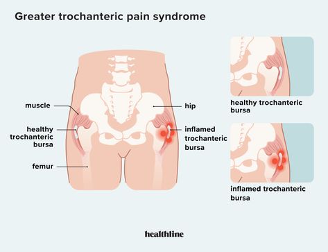 Greater Trochanteric Pain Syndrome, Snapping Hip Syndrome, Leg Spasms, Foam Roller Stretches, It Band Stretches, Types Of Surgery, Bones And Muscles, Hip Pain, Foam Roller