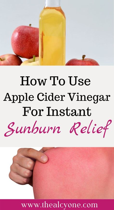 Apple Cider Vinegar Sunburn, Diy Sunburn Relief, Vinegar For Sunburn, Best For Sunburn, Remedies For Sunburn, Home Remedies For Sunburn, Aloe Vera For Sunburn, Natural Remedies For Sunburn, Sunburn Remedies