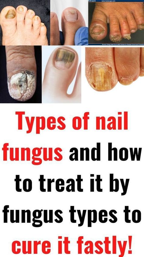 fungal nail remedies Fungal Infection Remedies, Toenail Health, Toenail Fungal Infection, Nail Remedies, Fingernail Fungus, Toenail Fungus Remedies, Nail Fungus Remedy, Fungal Nail, Toenail Fungus