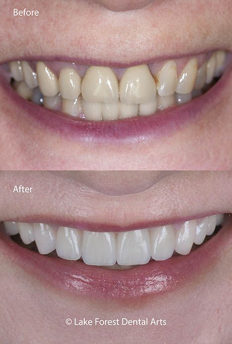 Front tooth crowns | 8 ways they can stand out. Blog post about why crowns don't match Porcelain Crown Front Teeth, Front Teeth Crowns Before And After, Crown Teeth, 12 Week Transformation, Medical Items, Dental Studio, Tooth Crown, Porcelain Crowns, Tooth Care