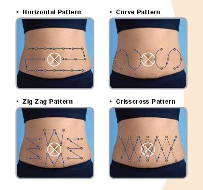 Site rotation - AccuChek~it would be a lot easier if I had no stretch marks from having a baby! Insulin Pump, Change Your Life, Type 1, Disease, Pumps, Health, Pins