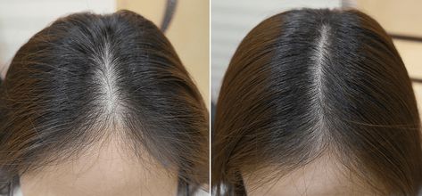 Vitamin C Is Being Used to Treat Thinning Hair and the Results Are Incredible - NewBeauty Hair Growth Men, Thinning Hair Women, Pink Makeup Ideas, Natural Hair Problems, Treat Thinning Hair, Thinning Hairline, Thining Hair, Make Hair Thicker, Thinning Hair Remedies